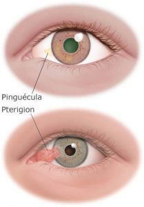 carnosidad de los ojos pterigion-pinguecula